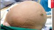 Woman has gigantic 61-pound tumor removed from uterus