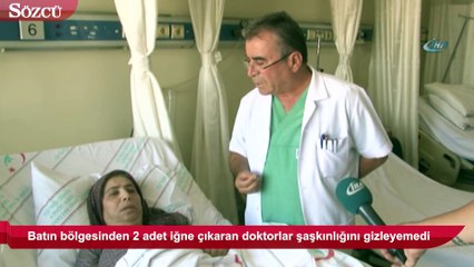Vücudundaki iğneler 66 yıl sonra çıkarıldı