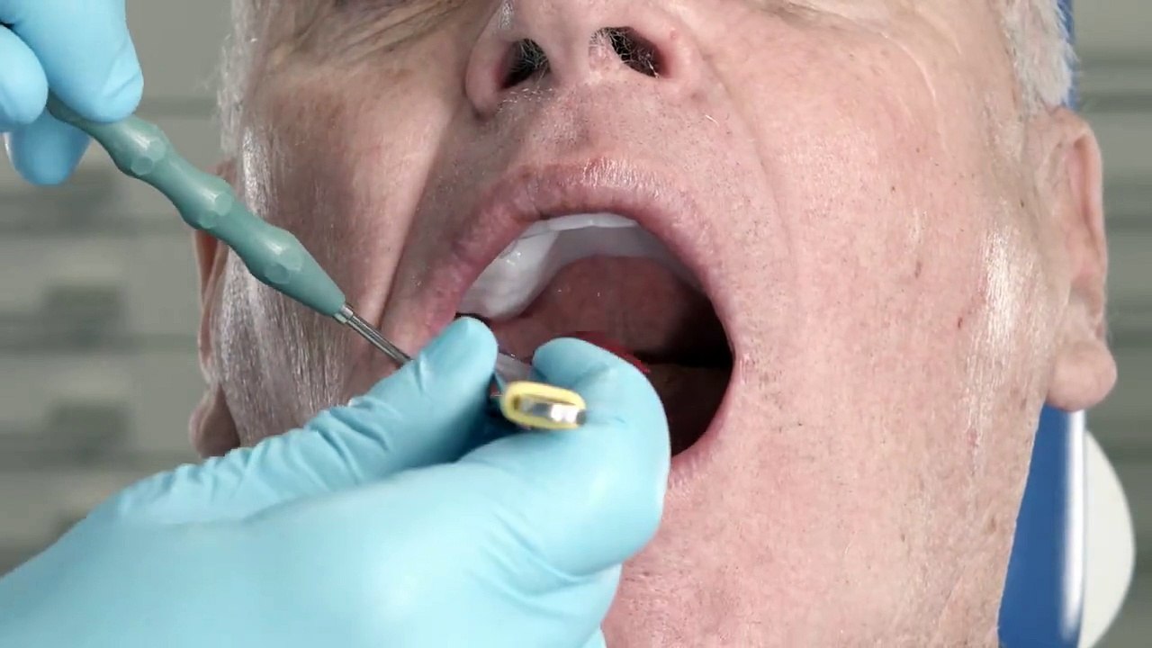 Digital Denture – third Appointment: Esthetic and functional try-in. Four Video Tutorials provide a practical insight into the dental procedures involved in the