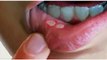 Canker Sores In The Mouth: Here Is How To Naturally Get Rid Of Them In A Matter Of Minutes