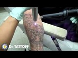 How Many Treatment For Tattoo Laser Removal