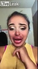 Lip Surgery Fail