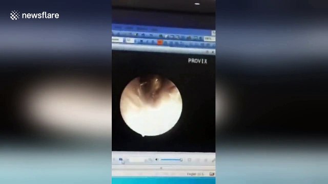 Disgusting moment cockroach crawls out of woman's ear