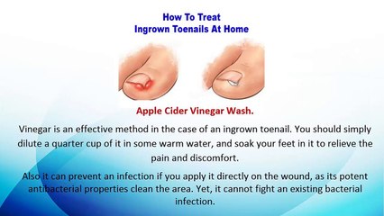 5 Remedies To Treat Ingrown Toenails At Home