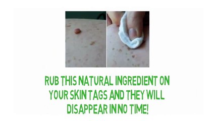 Rub This Natural Ingredient on Your Skin Tags and They Will Disappear in No Time!