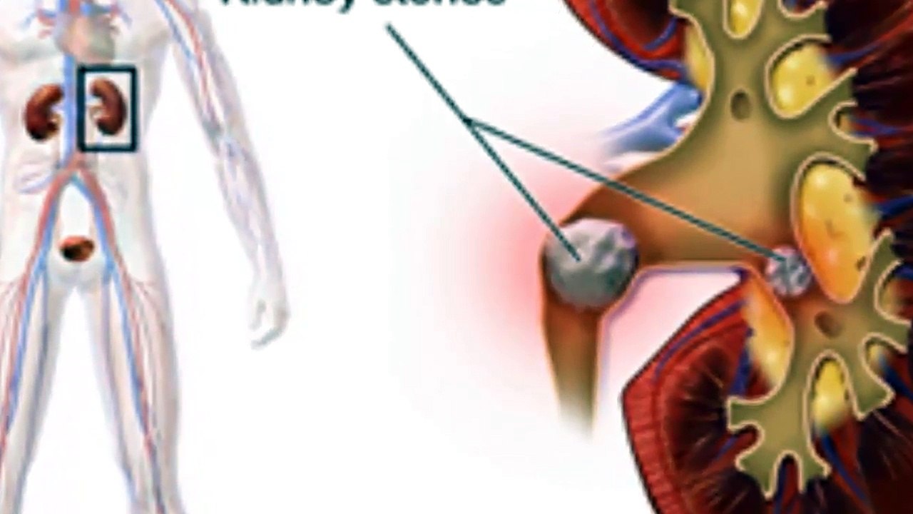 How To Make The Most Powerful Juice That Naturally Removes Kidney Stones And Gallstones!