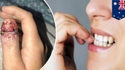 Student develops skin cancer from biting her nails