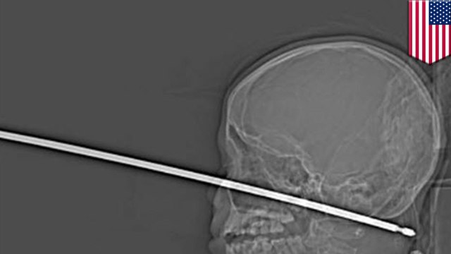 Boy survives being impaled by skewer through face and skull