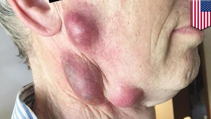 Man left with painful boils after catching rare disease from pet cat