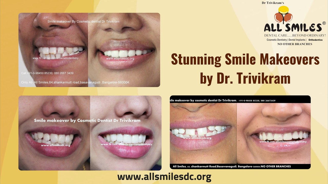Smile Makeover Treatment in Bangalore | Cosmetic Dentistry | Smile Makeover Procedure in Karnataka