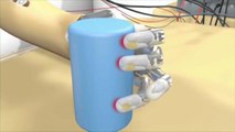 Una mano bionica sempre più 