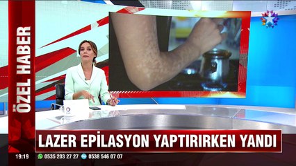Genç Kadın Lazer epilasyonu yaptırırken böyle yandı