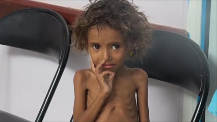 تزايد حالات الفقر وسوء التغذية بين أطفال اليمن