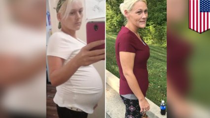 20-pound ovarian cyst removed from woman's stomach