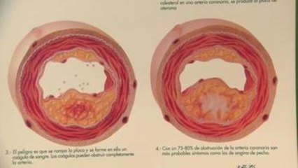 La Hipercolesterolemia Familiar afecta a la mitad de la descendencia de las personas que lo padecen