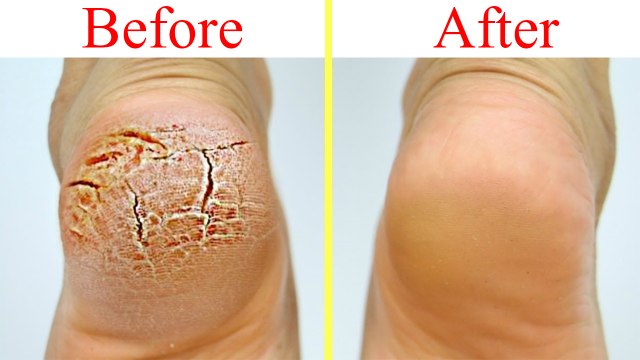 Cracked Heels Treatment at Home DIY: फटी एड़ियों से पाएं छुटकारा | Boldsky