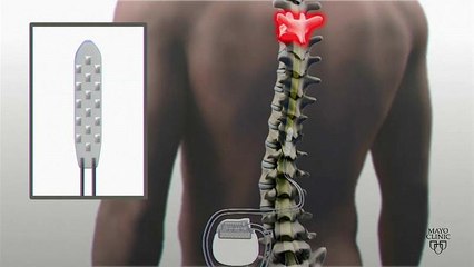 La stimolazione elettrica aiuta un ragazzo paraplegico a camminare di nuovo