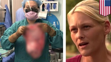 妊婦のように腹部膨らむ…9キロの卵巣嚢腫を摘出した女性 - トモニュース
