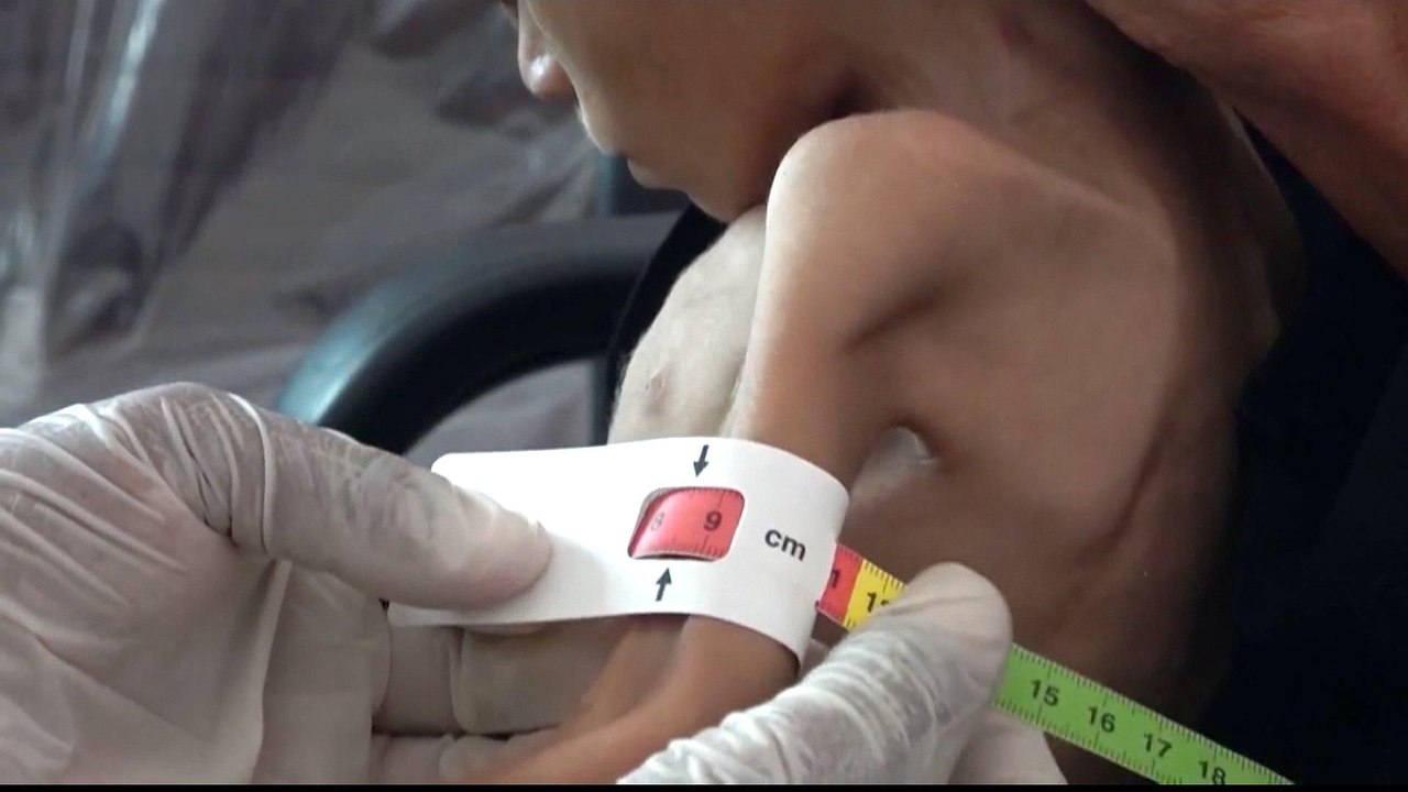 ’I could count the ribs on her chest’: Yemeni refugees starving