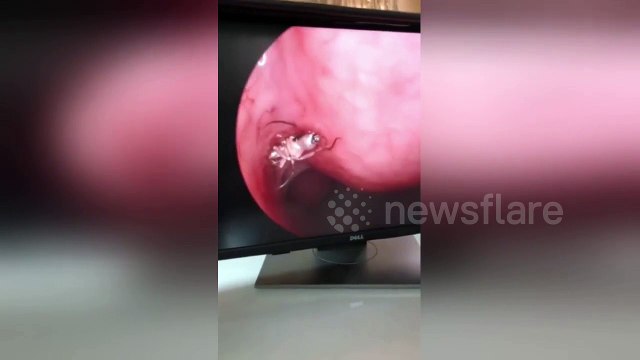 Stomach-churning footage shows twitching mosquito deep inside man's nose