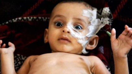 أنقذوا الأطفال: الكوليرا تتضاعف ثلاث مرات بالحديدة