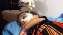 سوء التغذية يفتك بالأطفال في مديرية الأزارق اليمنية