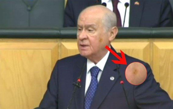 Bahçeli'nin Yüzündeki Morluk, Grup Toplantısına Damga Vurdu