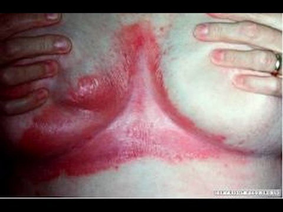 ¿Qué es la psoriasis? / Enfermedades de la piel