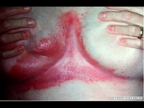 ¿Qué es la psoriasis? / Enfermedades de la piel