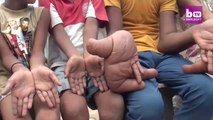 Cet adolescent indien a des mains géantes - Maladie impressionnante