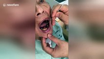 'Pebble' found lodged in man's palate in Vietnam
