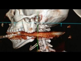 Mujer brasileña sobrevive tras recibir de su esposo un disparo con arpón