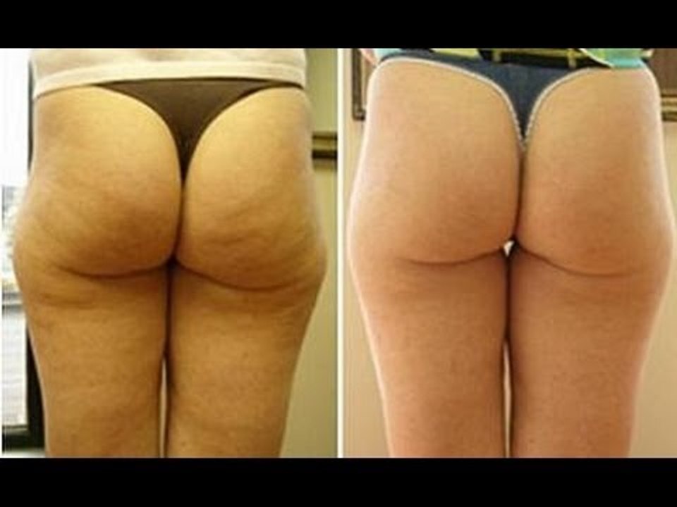 ¿Se puede quitar o disminuir la celulitis? / Di...