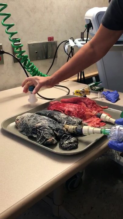 Une infirmière explique ce que le tabagisme fait chaque jour à vos poumons