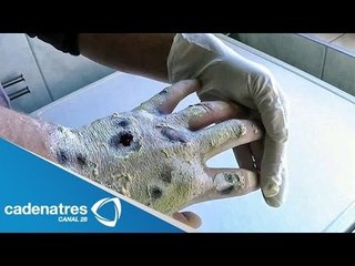 Secretario de salud asegura no haber consumo de la droga krokodil en Tijuana