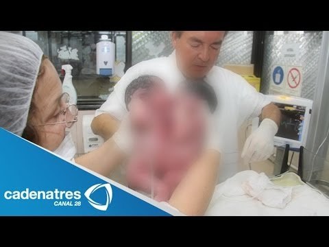 Siamesas que nacieron pegadas del tórax, son operadas y evolucionan favorablemente