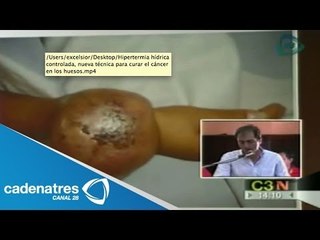 Hipertermia hídrica controlada, nueva técnica para curar el cáncer en los huesos