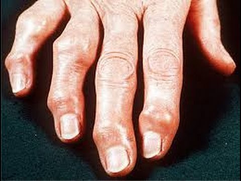 ¿Qué es y cómo identificar un caso de osteoartritis?