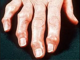 ¿Qué es y cómo identificar un caso de osteoartritis?