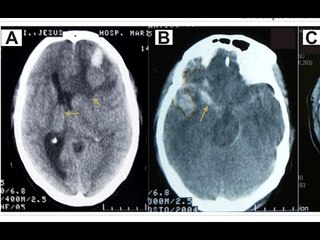 Cómo ayudar a una persona que sufrió una contusión en el cráneo