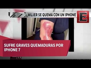 Mujer se queda dormida sobre un Iphone y sufre terribles quemaduras