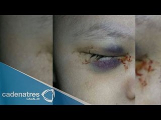 Negligencia médica en el IMSS: Extirpan ojo sano a un niño