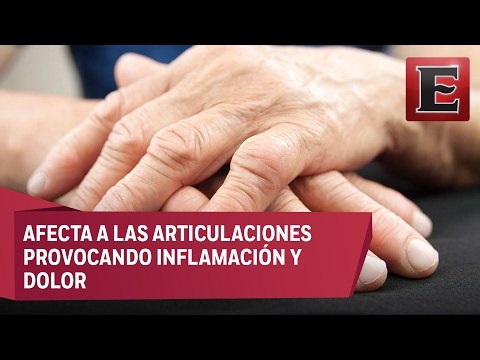 La artritis reumatoide: Causas, síntomas y tratamiento