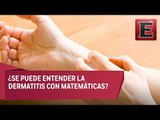 ¿Qué relación tienen las matemáticas con la dermatitis atópica?
