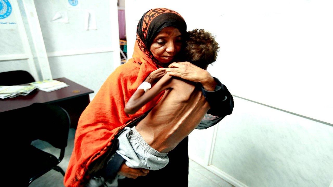 Thousands of Yemeni children malnourished