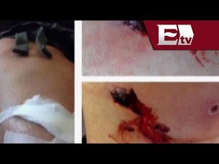 Montserrat Oliver se mete en las favelas en brasil y es mordida por un perro / JC Cuéllar