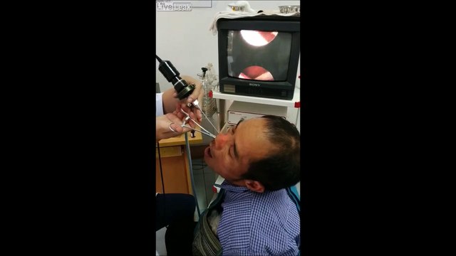 Un médecin retire une sangsue du nez de cet homme