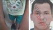 Perú: Hombre quema las manos de su hijastro como forma de castigo
