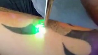 The laser tattoo removal process is crazy to watch 