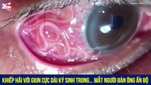 Khiếp hãi với giun cực dài ký sinh trong... mắt người đàn ông Ấn Độ